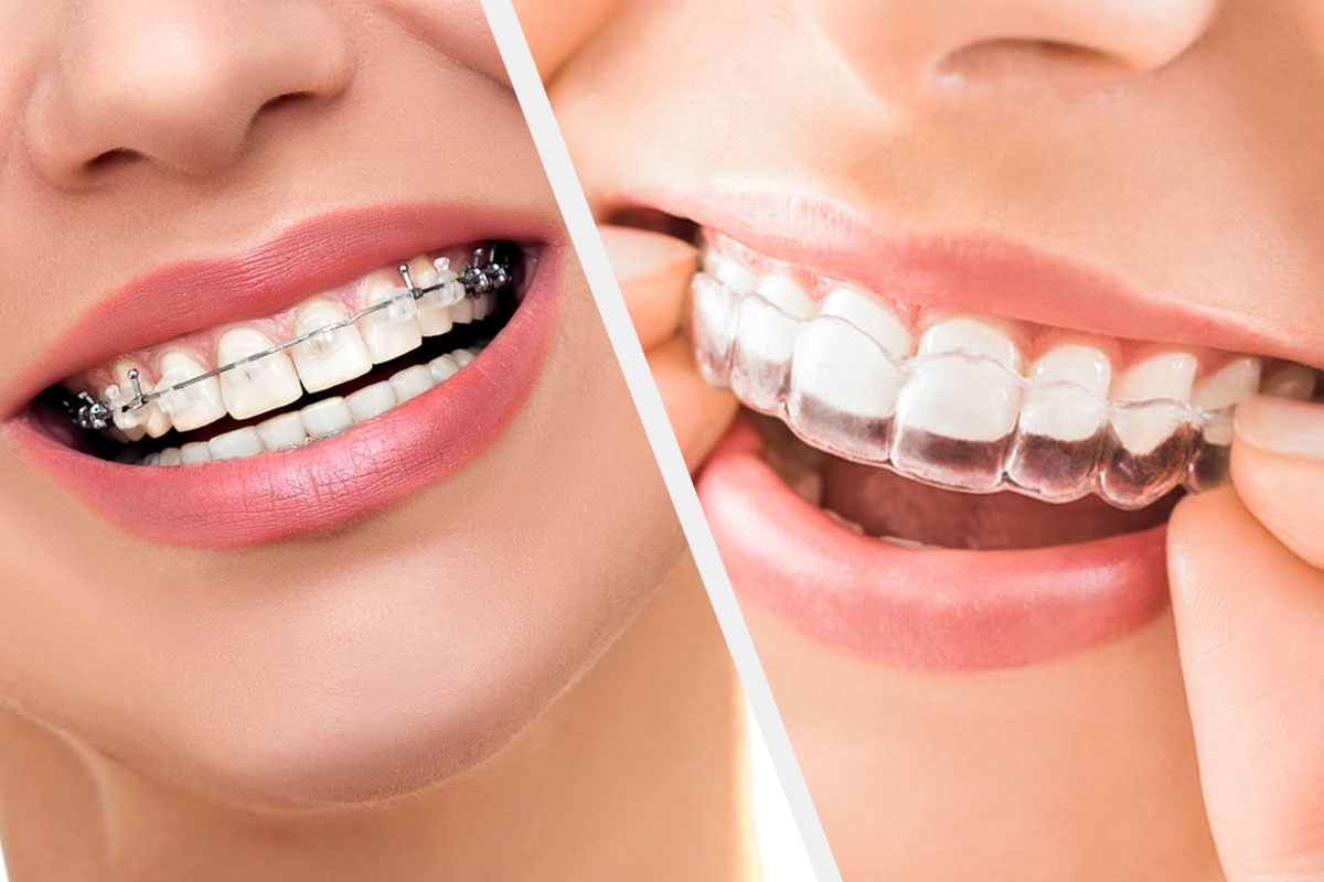 Braces Vs Invisalign