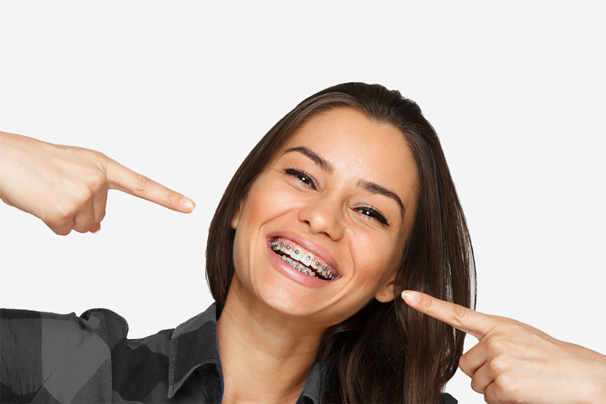 Adult Braces