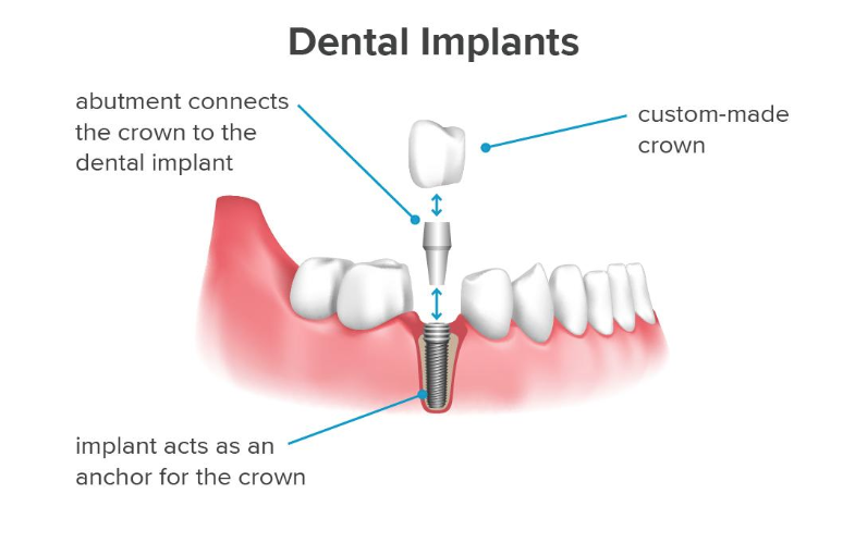Dental Implants