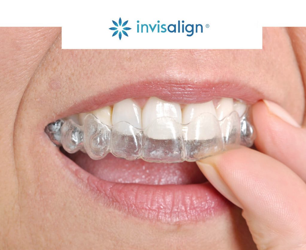 Adult Braces