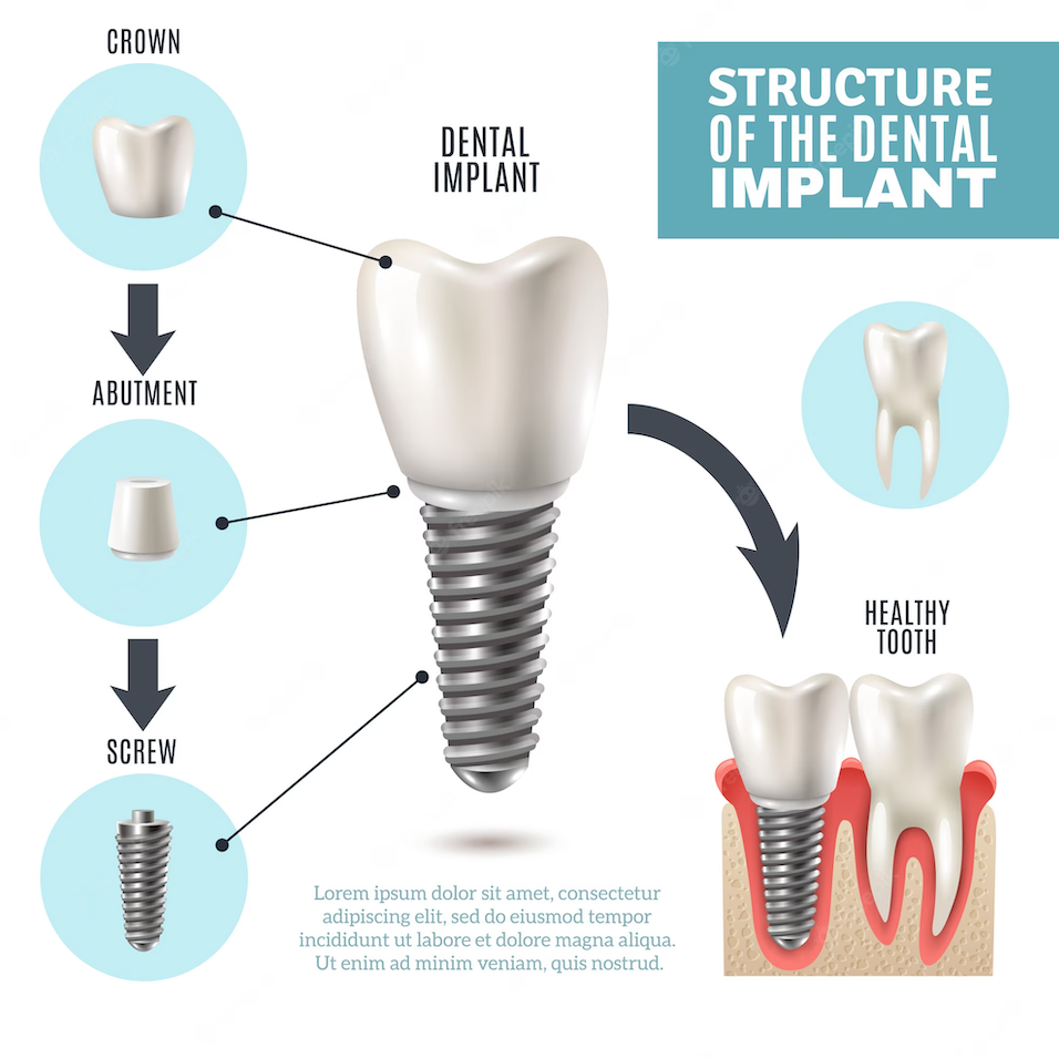 Types of Dental Implants