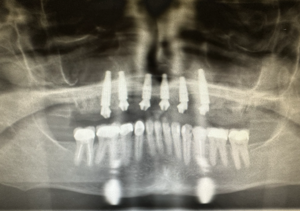 dental implants layton ut