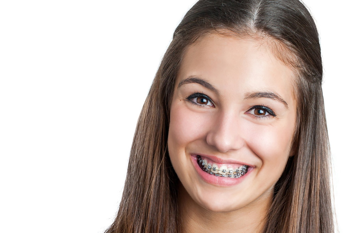 affordable braces