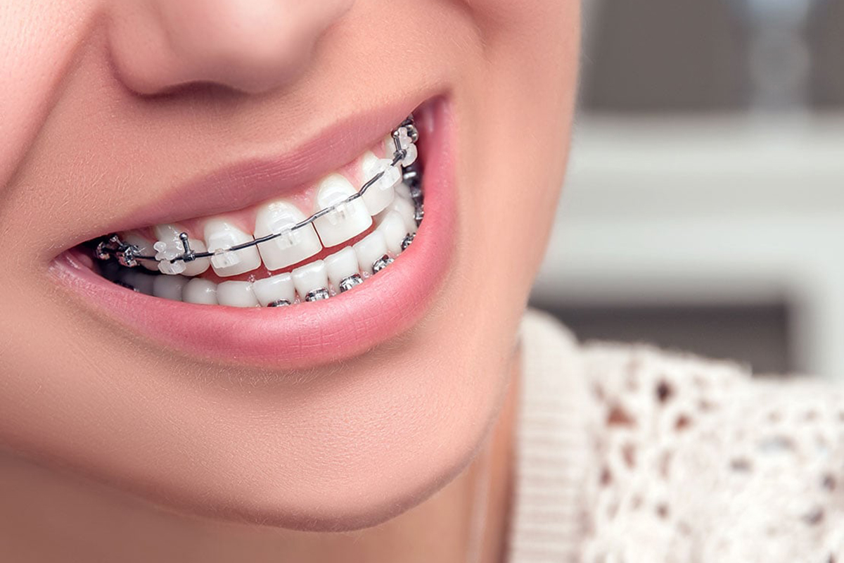 Ceramic Braces