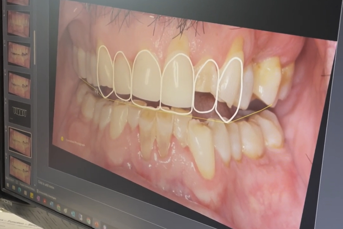 worn down teeth