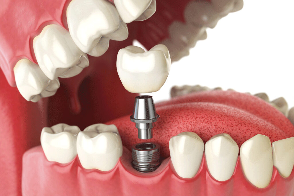 Dental Implant Breaks