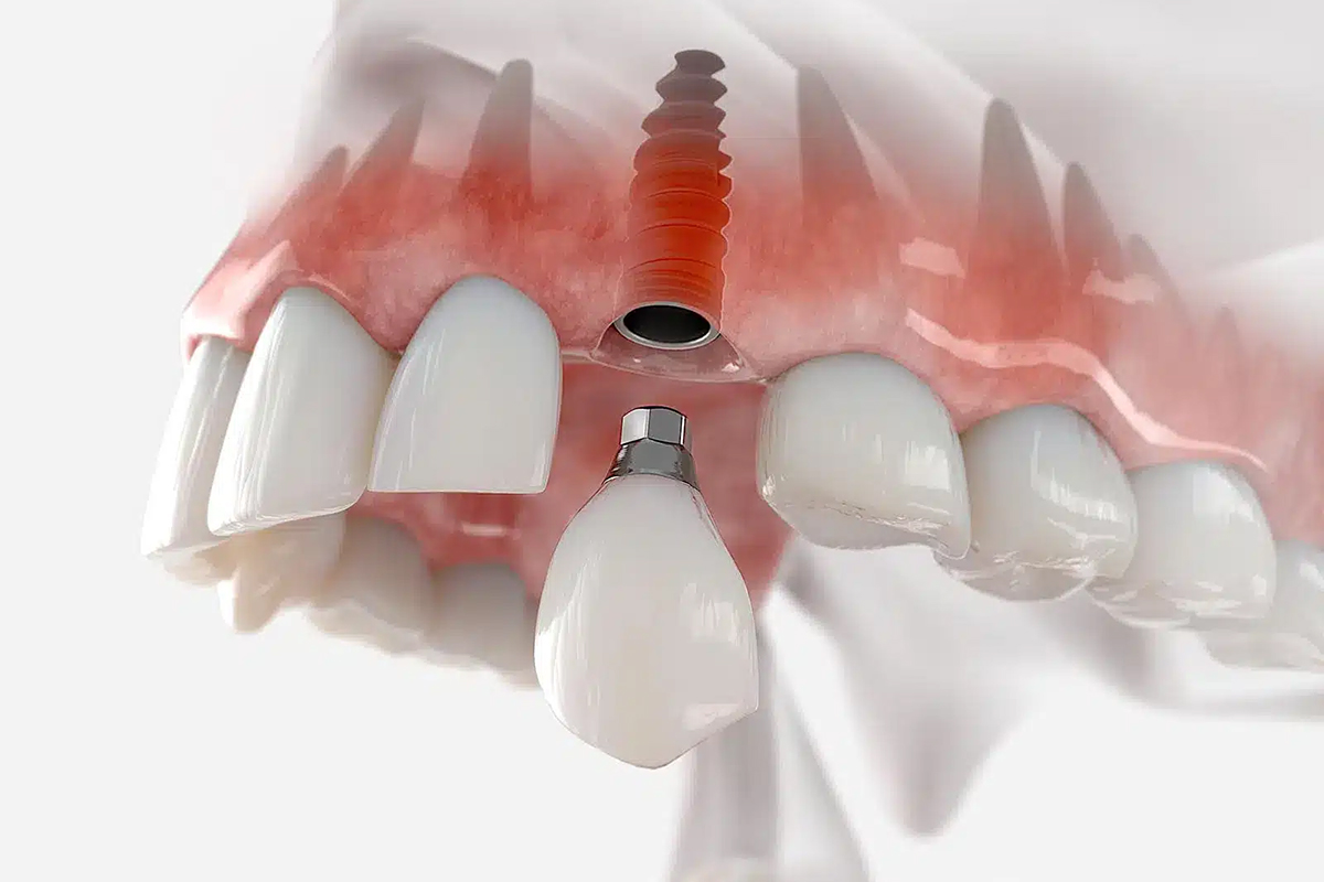 Dental Implant Breaks
