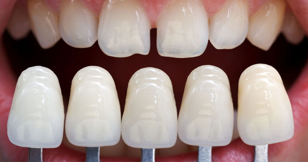tooth shape