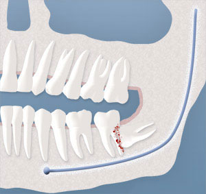 Wisdom Teeth Removal In Davis County