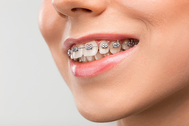Braces in Layton Utah