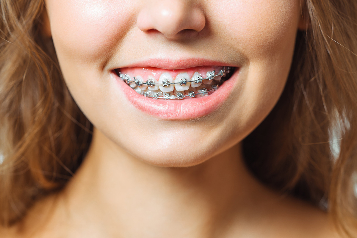 Braces in Davis County