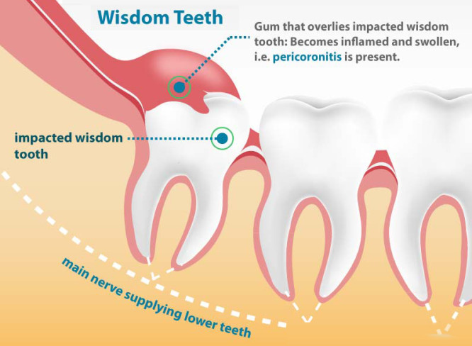 Wisdom Teeth Extraction Layton UT