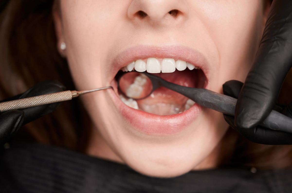 Wisdom Teeth Extraction Layton UT